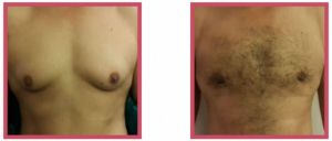 Gynaecomastia Treatment Services