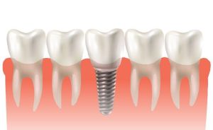 Dental Implants in India