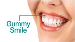 Gummy Smile Correction Treatment Services