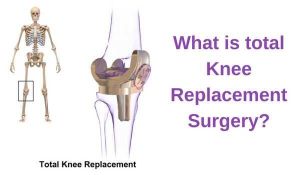 Knee Replacement Surgery