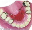 Upper Molars
