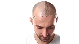 follicular hair transplant