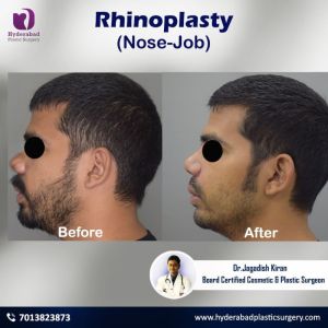 rhinoplasty nose surgery