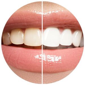 Teeth Whitening And Bleaching Treatment Services