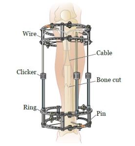 External Fixators