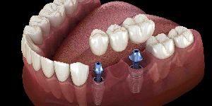 Dental Implants