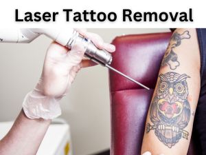 laser tattoo removal treatment
