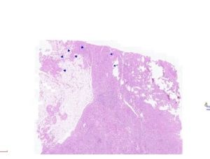 Angiomyolipoma Microscope Slide