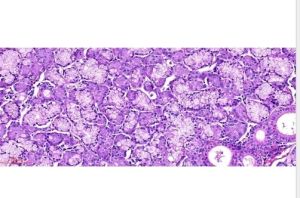 E Slide Of Epithelial Lesions