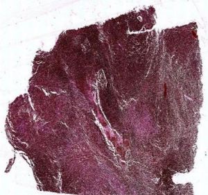 Malignant Melanoma Prepared Microscope Slide