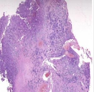 Neuroblastoma Pathology Prepared Slide