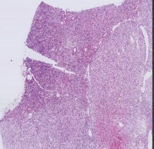 Pathology Prepared Slide Renal Cell Carcinoma