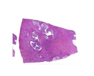 Pathology Pyonephrosis Kidney Microscope Slide