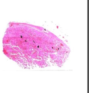 Phecromocytoma Pathology Prepared Slide