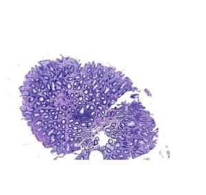 Solitary Rectal Ulcer Histopathology Slides