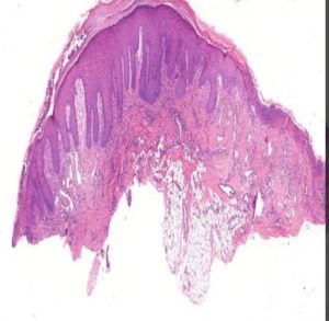 Traumatic Ulcer Tongue Prepared Microscope Slide