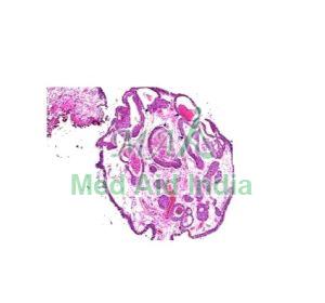 Cystitis Cystica Prepared Microscope Slide