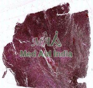 Malignant Melanoma Prepared Microscope Slide