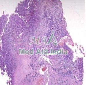 Plain Neuroblastoma Pathology Prepared Slide, For Clinical, Laboratory, Feature : Eco Friendly, Superior Quality