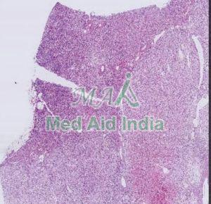 Pathology Prepared Slide Renal Cell Carcinoma