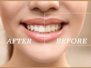 teeth cleaning whitening service