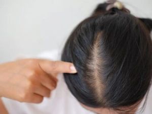 Hair Fall Treatment In Lucknow