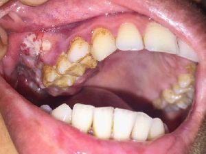 Laser Root Canal Treatment