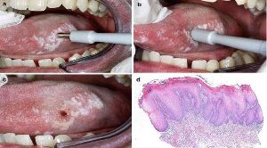 Occlusal Splint Therapy