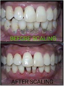 Teeth Cleaning Services