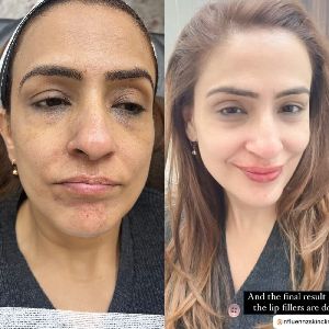 Anti Aging Treatment