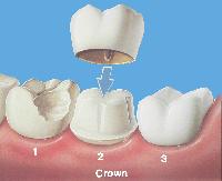 Dental Crown