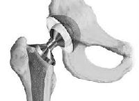 Artificial Hip Joints