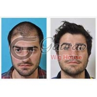 Hair Replacement System