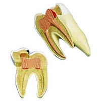 Upper Triple Root Molar with Caries