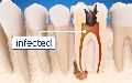 Root Canal Treatment service