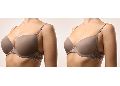 Breast Liposuction Surgery Treatment Services