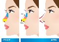 Flat Nose Surgery Treatment Services