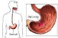 Gastric Ulcer Treatment