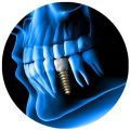 Dental Implant Treatment Services