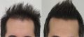 Non Surgical Hair Transplant